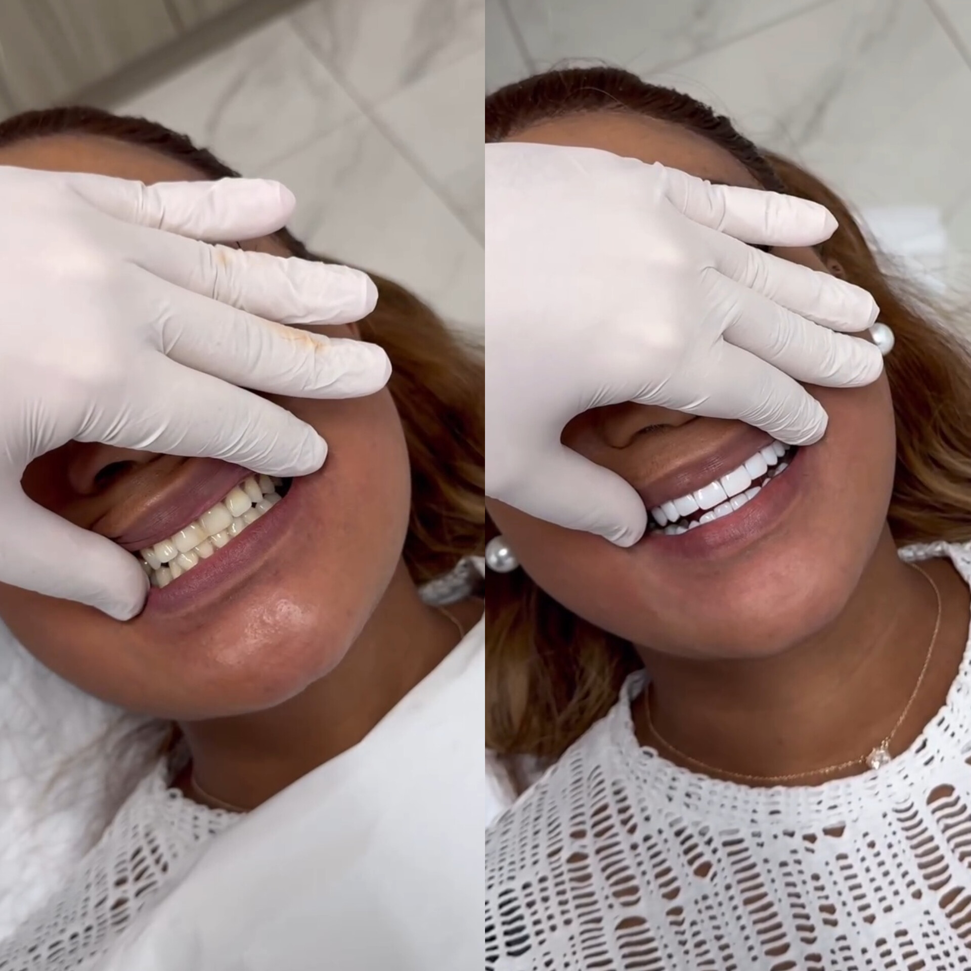 Transformation sourire avec facettes composite